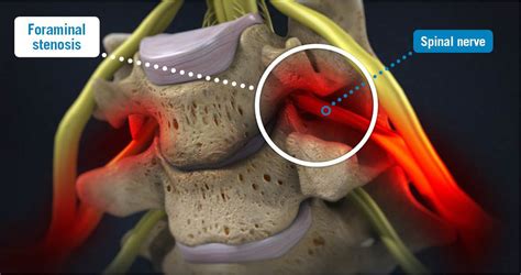 The part of the nerve where compression occurs is called the nerve root. . Moderate cervical foraminal stenosis symptoms
